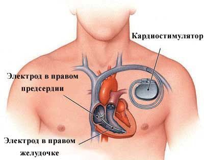 Как повысить пульс при брадикардии?