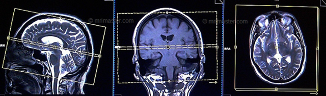 Ангиография (МРА) головного мозга. Личный опыт
