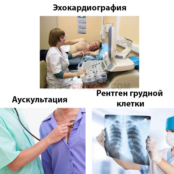 Трикуспидальная регургитация: степени, причины, лечение. Минимальная митральная регургитация что это такое