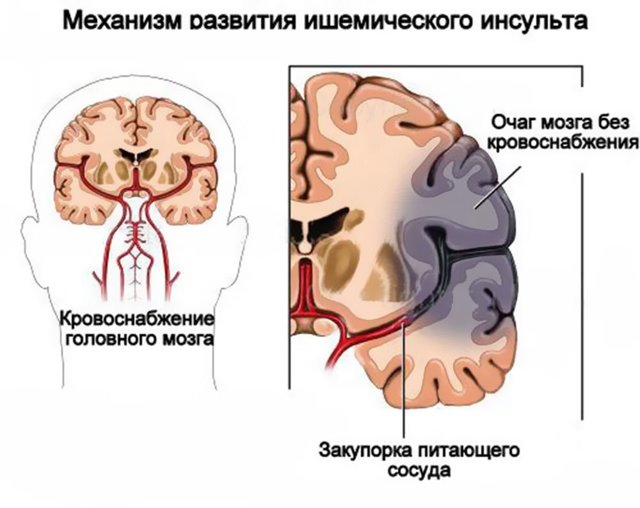 Ишемический инсульт: симптомы и лечение