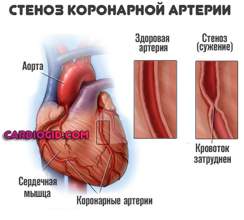 Повторный инфаркт миокарда: признаки, профилактика
