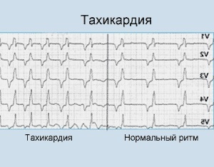 Тахикардия сердца: симптомы, диагностика и лечение - DELFI
