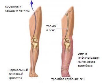 Тромбоз. Тромбофлебит вен нижних конечностей. Лечение и симптомы тромбоза и тромбофлебита.