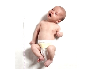 Мышечная гипотония у новорожденных и детей