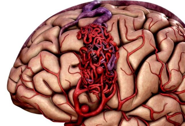 Васкулит мозга