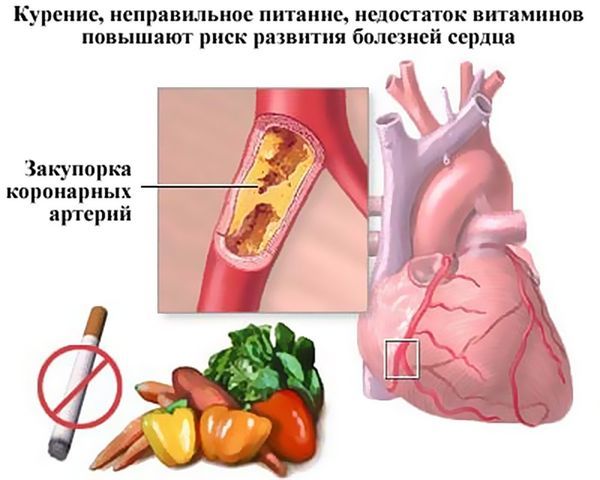 Профилактика ИБС или ишемической болезни сердца