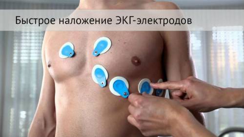 Наложение электродов при ЭКГ: как их накладывать, схема наложения и постановки