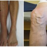 Отеки при варикозе - снимаем быстро и надолго