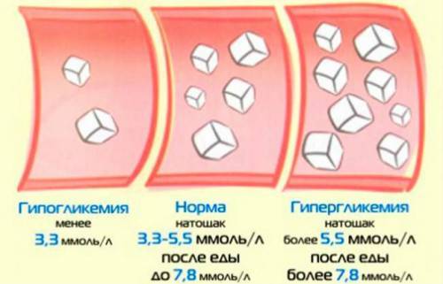 Первые признаки и симптомы сахарного диабета