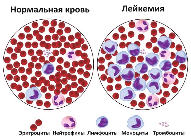 Что значит если средний объем эритроцитов повышен или понижен