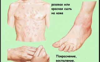Ревматизм - причины, признаки, симптомы и лечение