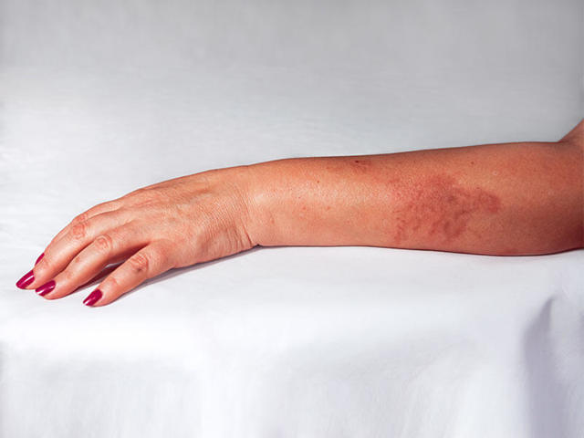 Сульфаргин - инструкция и показания к применению