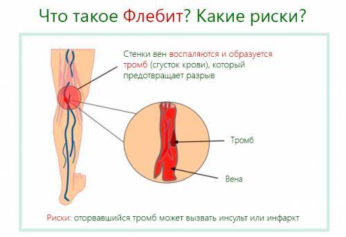 Флебит - что это такое, причины, симптомы, лечение