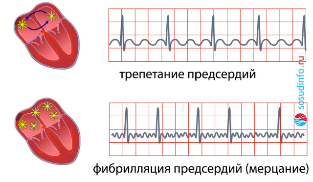 Нормосистолия, тахисистолия и брадисистолия на ЭКГ: что это, норма и патология