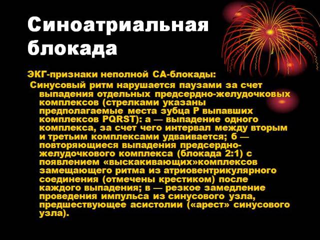 Нарушение внутрижелудочковой проводимости сердца что это такое?