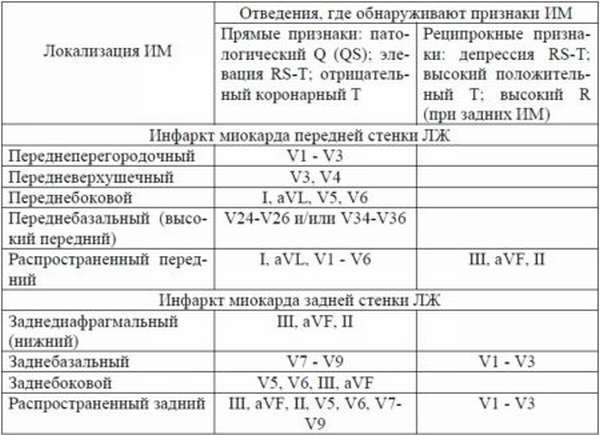 Инфаркт миокарда на ЭКГ: признаки, расшифровка