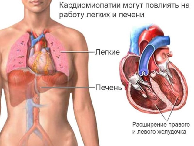 Кардиопатия сердца: симптомы, диагностика и лечение. Что такое кардиопатия у детей? Кардиопатия у детей и взрослых: причины, симптомы, лечение и возможные последствия.