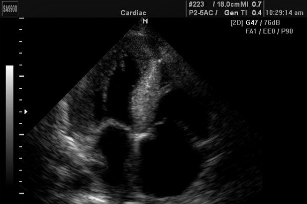 Эхо КГ сердца что это такое, как делают