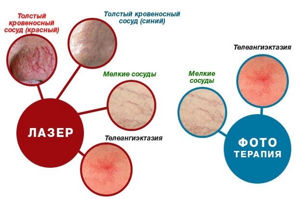 Как удалить сосудистые звездочки на лице? Узнайте о достижениях современной медицины.
