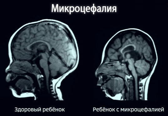 Вирус Зика - причины, симптомы и лечение Zika virus