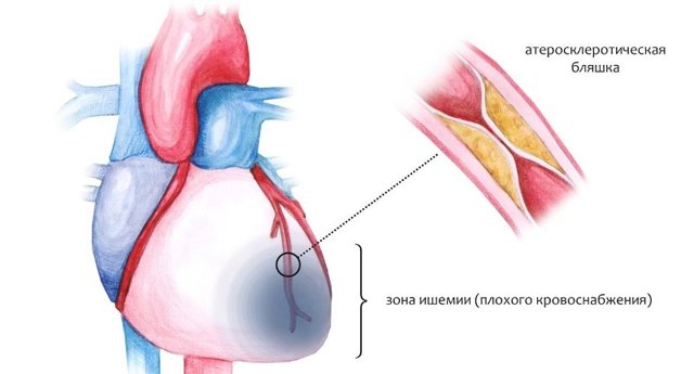 Осложнения после стентирования сосудов сердца и коронарных артерий - компания Стентоник