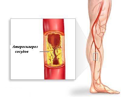 Болезни сосудов ног, лечение сосудов нижних конечностей