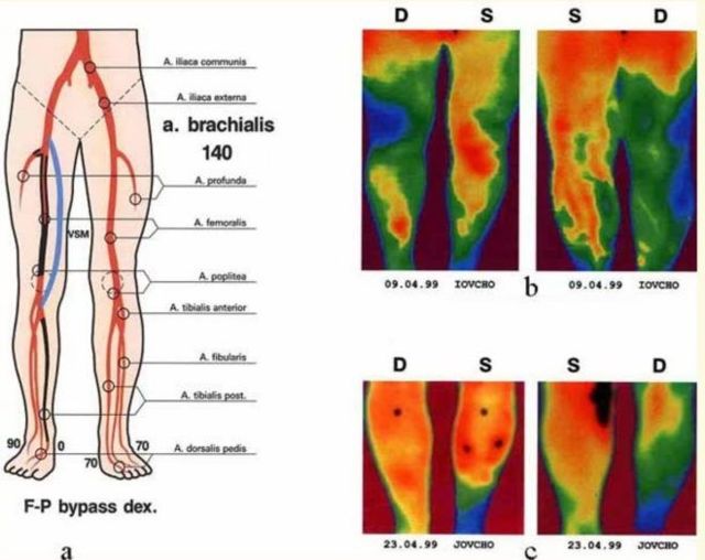 Облитерирующий эндартериит сосудов нижних конечностей - симптомы и лечение