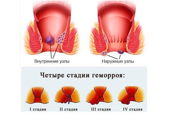 Свечи от геморроя - недорогие и эффективные свечи от геморроя при шишках