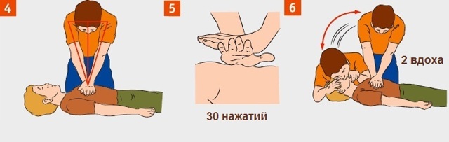 Закрытый массаж сердца., Методика выполнения закрытого массажа сердца - Основы реанимации
