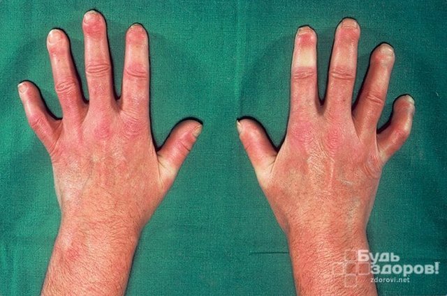 Системная склеродермия - диагностика, лечение, прогноз