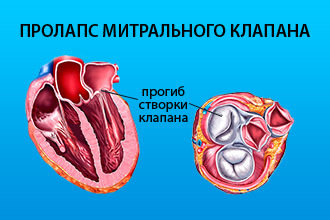 Порок митрального клапана сердца
