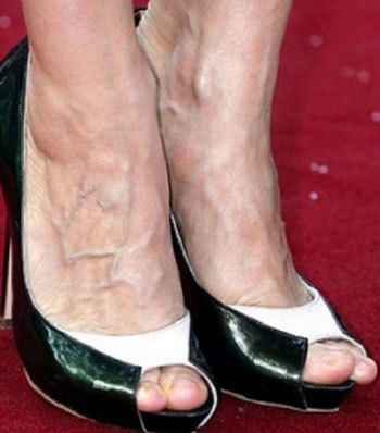 Почему видны вены на руках и как их убрать?