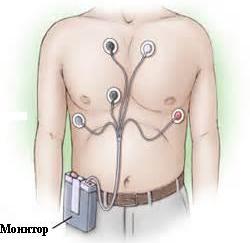 Холтеровское мониторирование сердца (суточное ЭКГ): что это?