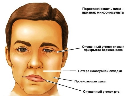Микроинсульт – симптомы и последствия, признаки, лечение, или Берегите здоровье смолоду