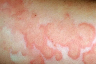 Ревматизм сердца симптомы и лечение — Сердце