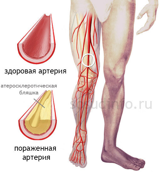 Перемежающаяся хромота - что это такое? - Лечение ног