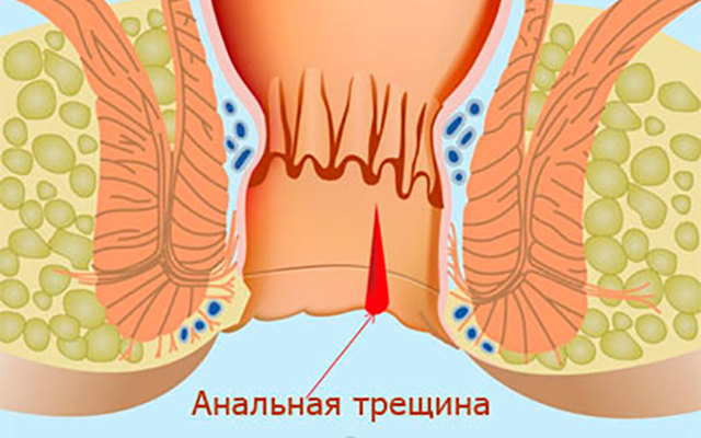 Лечение трещины заднего прохода без операции