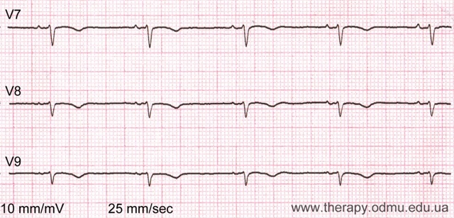 Стандартные отведения от конечностей - 1,2,3