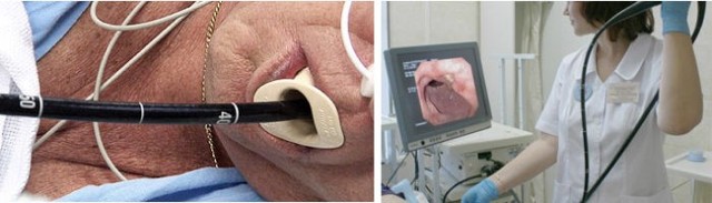 Эрозивный гастрит – симптомы, лечение, диета, осложнения, профилактика