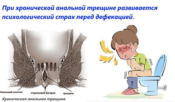 Лечение трещины заднего прохода без операции