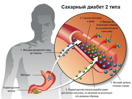 При сахарном диабете - как лечить и чистить сосуды?
