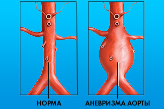 Аневризма аорты восходящего отдела, расширение аорты - лечение. Протезирование аорты в СПб