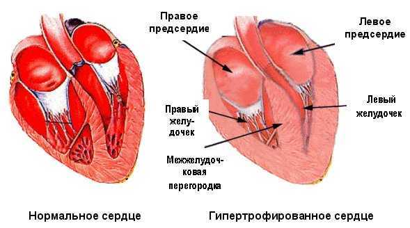 Гипертрофия левого желудочка сердца: признаки на ЭКГ и лечение