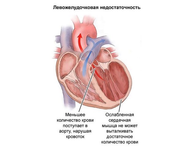 Кардиогенный отек легких - причины, симптомы, диагностика и лечение
