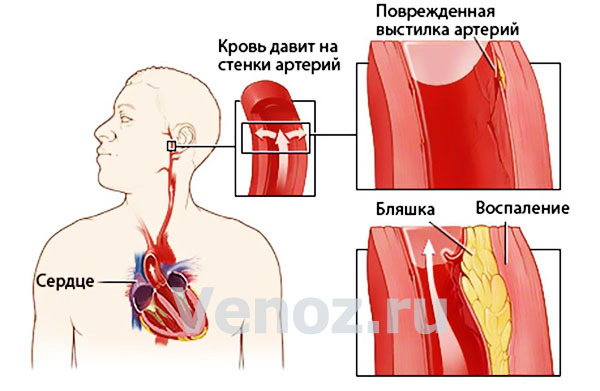 Лечение сосудов: как лечить болезни и заболевания сосудов и вен