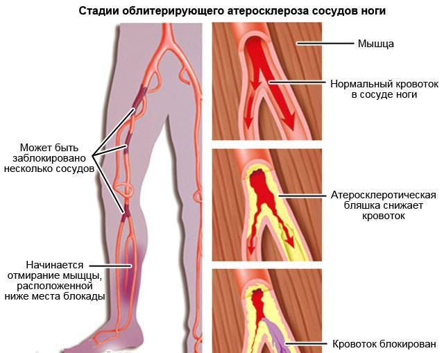 Облитерирующий атеросклероз сосудов нижних конечностей – симптомы и лечение