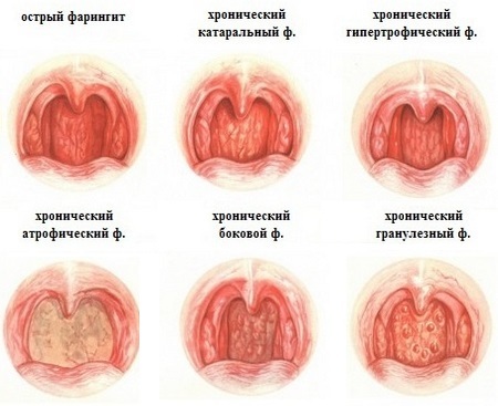 Фарингит у взрослых – симптомы и лечение фарингита у взрослых