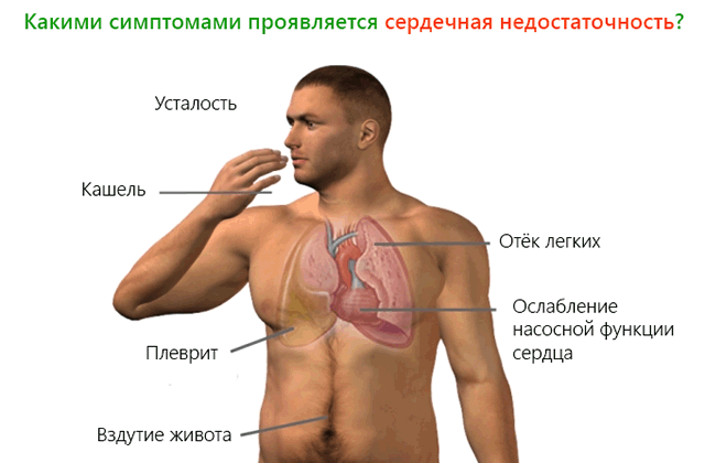 Внезапная смерть от сердечной недостаточности: причины и как этого избежать