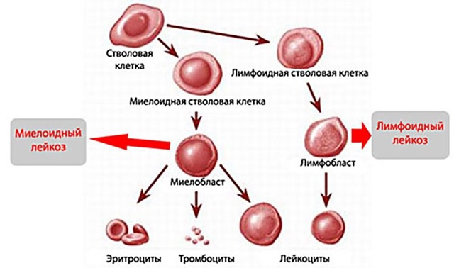 Лейкоз - злокачественное заболевание крови