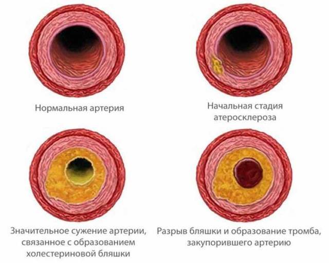 Тромб в сонной артерии: лечение, симптомы и удаление